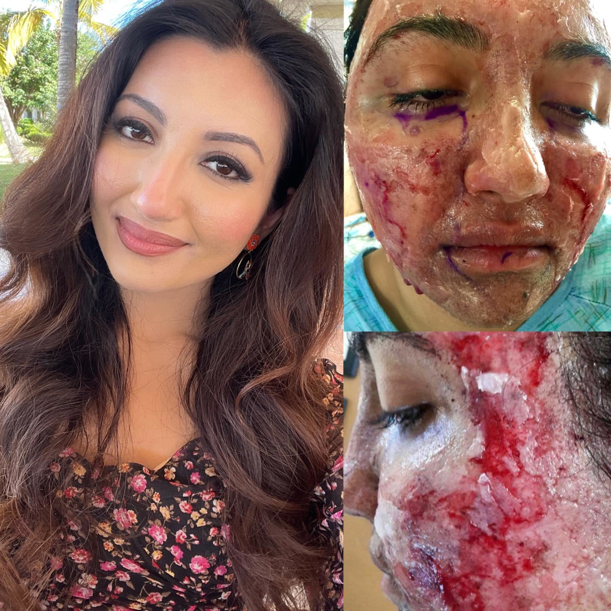 Shree Saini facial wounds